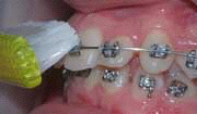 brossage dents et appareil dentaire